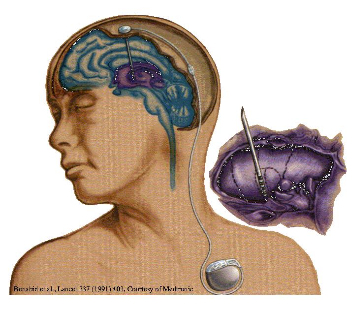 Deep brain stimulation strong synchronization of neuronal clusters may cause different disease symptoms like peripheral tremor (Morbus Parkinson) or