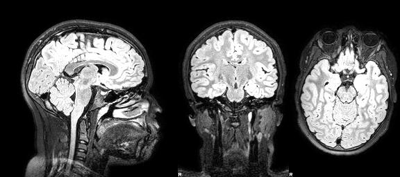 MR Images of Brain