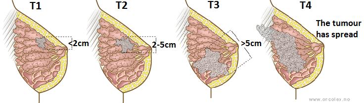 Figure 6.6.: Illustration of T stages 1 to 4 of breast cancer 5. The grey coloured area represents the tumour. Classes T1, T2, and T3 are characterised by the increasing size of the tumour.