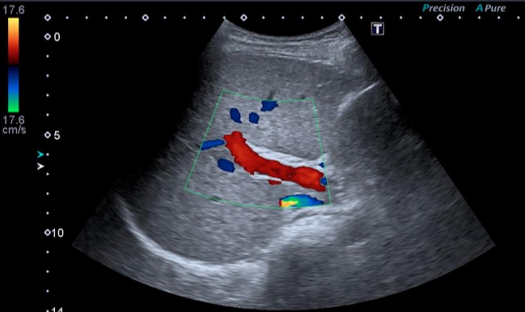 Fig. 17: Gray scale and Color Doppler examitaion over a box of interest in the hepatic hilum.