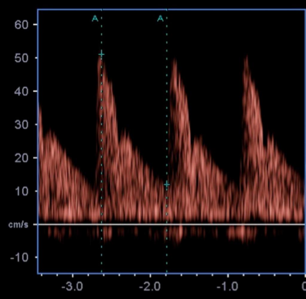 Fig. 20: Spectral representation showing how to calculate the resistive index.