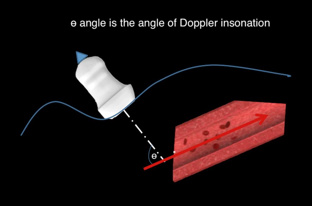 IMPORTANCE OF DOPPLER ANGLE In the B-mode, when we examinate structures with specular surfaces, an incidence of 90 is ideal to obtain a stronger echo. In Doppler measurement the opposite occurs.