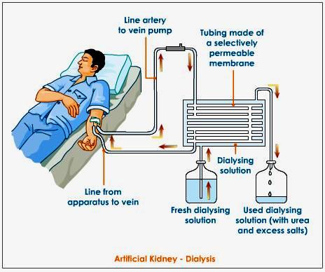 Dialysis