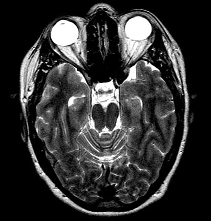 resonance to image tissue MRI normally