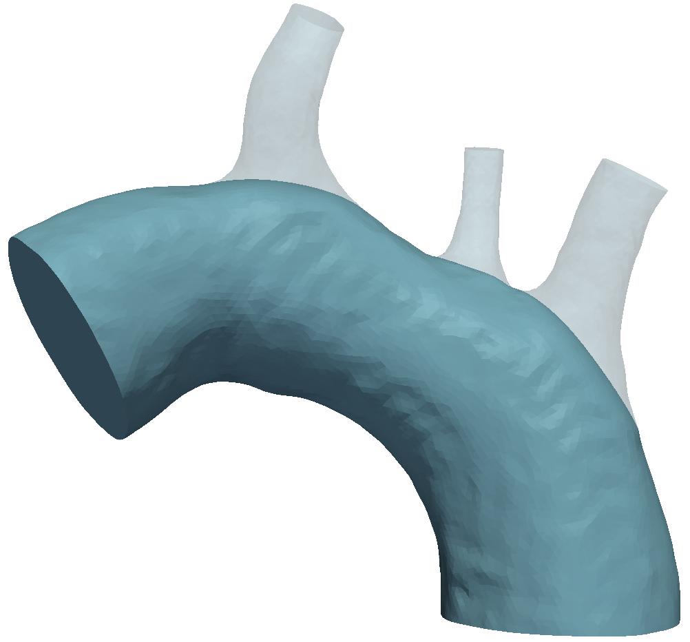 Figure 1: Patient specific model of te aortic arc including te