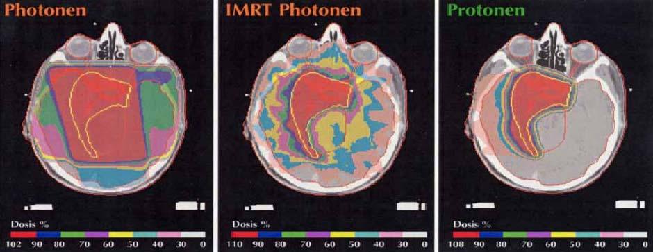 On the other hand, conventional high- energy X-rays X delivers the major share of radiation dose outside the tumour volume.