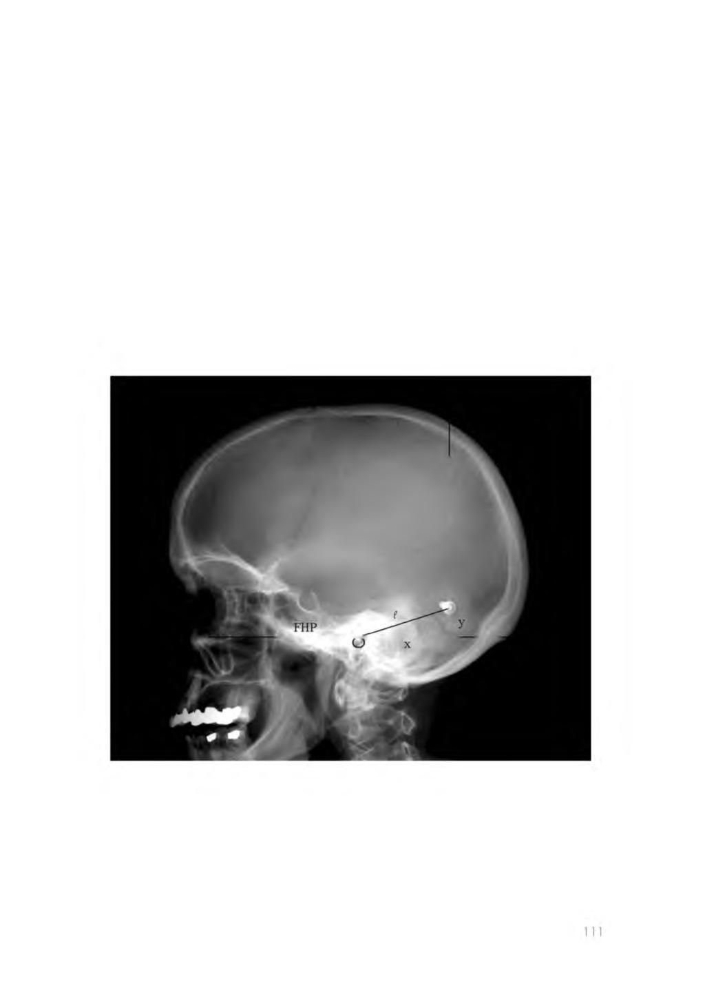 BAHA surgery; implant location, soft tissue reaction and thickness Implant position A standardized digital lateral conventional radiograph of the whole skull (Siemens, Erlangen, Germany), taken of