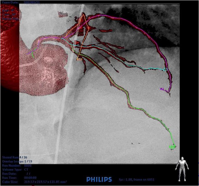 Clinical Applications (5) Stenting: Overlay visualiz.
