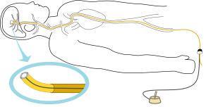 Medical applications Figure: Catheter activation by an IPMC type bending