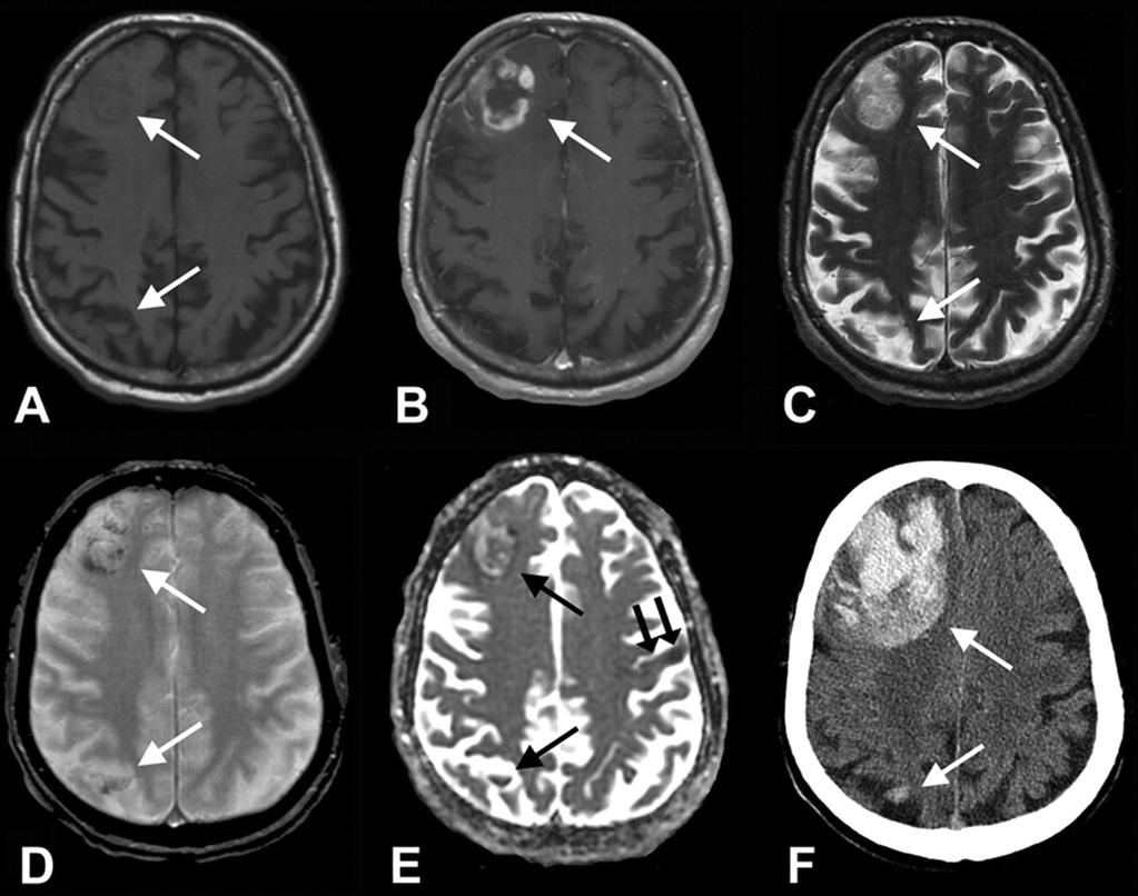 Example: Conventional MRI Brain Hemorrhage T1 T1+Gad T2 Why does water from different tissues appear different on MRI?