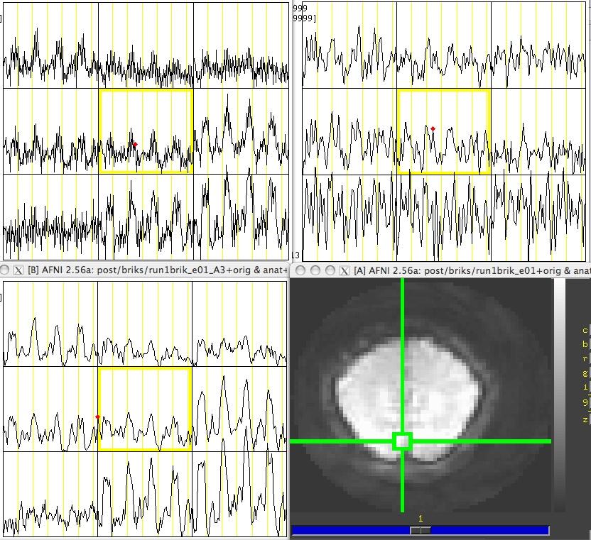 relaxation rate of tag during TI T 2 /T 2 * shift changes ASL signal during image