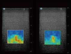 Ultra-wide Beam Tracking Imaging noise in the far field for deeper tumors.