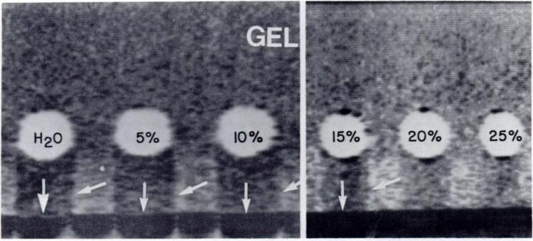 -Mechanism of acoustic shadowing caused by refraction of ultrasound.
