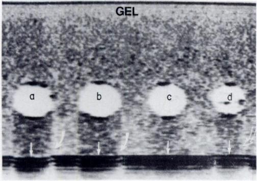 Appearance of far wall (straight arrows) of phantom mdicates acoustic velocities in bile fractions are (left to right): lower than gel for first two specimens, about equal gel in the third, and