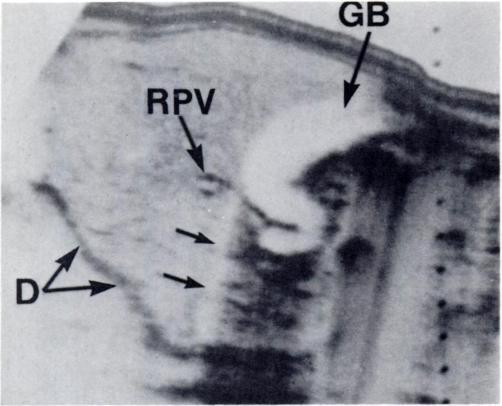 976 SOMMER ET AL. AJR:132, June 1979 Fig. 9.-Shadowing (arrows) observed from interface of body of gallbladder (GB) and liver. Convoluted nature of cystic duct could not Fig. 10.