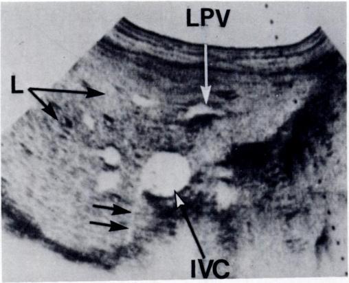 A Shadows occurring at the junction of the gallbladder and liver parenchyma are commonly seen and are often particularly evident at the gallbladder neck where they may raise the suspicion of