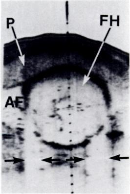 Acoustic shadows secondary to the mechanism of critical angle of reflection are also evident. The most common examples are seen in obstetric ultrasonography B Fig.