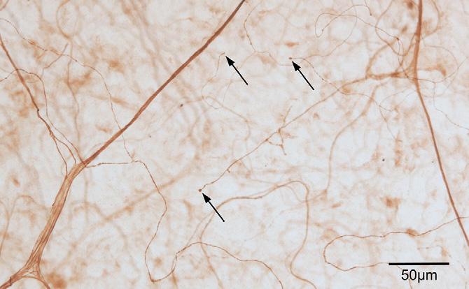 Some of the straight or curvilinear fibers penetrate Bowman's membrane and give rise in a more superficial plane to subbasal nerve fibers (snf). in a central direction.