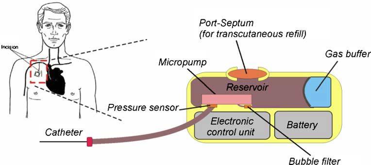 Implantable Microport System Concept of an active microport Geipel, A., et al. 2008.
