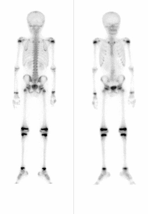 scintigraphy an image presenting bone metabolism.