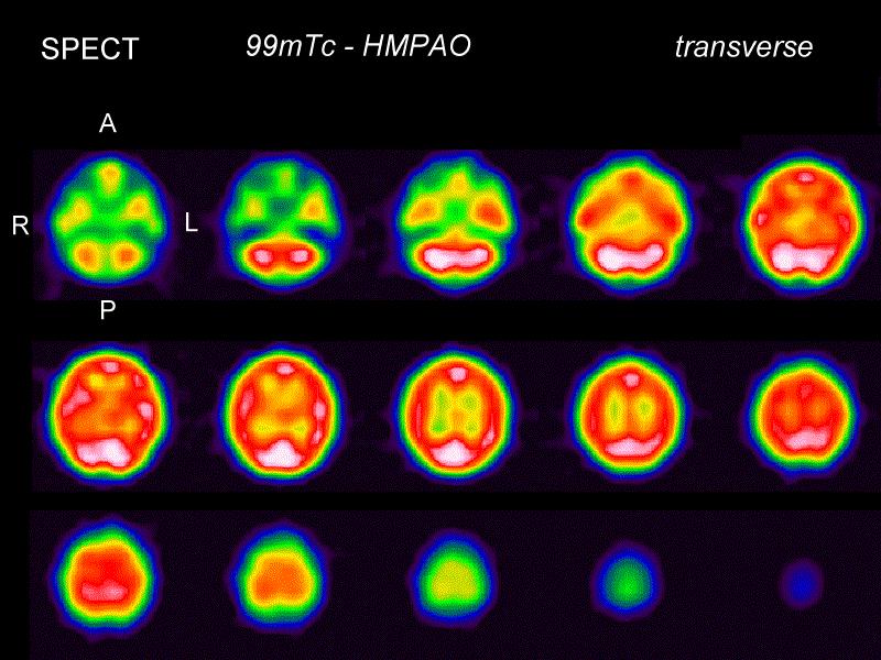 Brain SPECT perfusion study after Tc-HMPAO administration Transverse planes