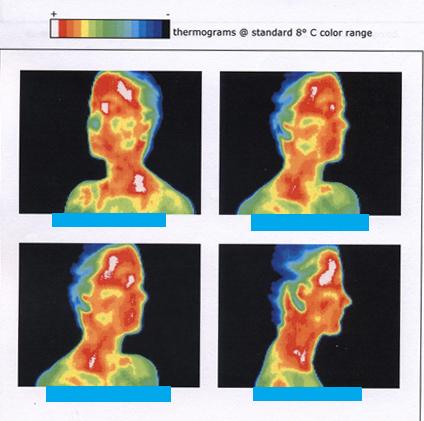 OpenStax-CNX module: m42214 8 Figure 5: This image of radiation from a person's body (an infrared thermograph) shows the location of temperature abnormalities in the upper body.