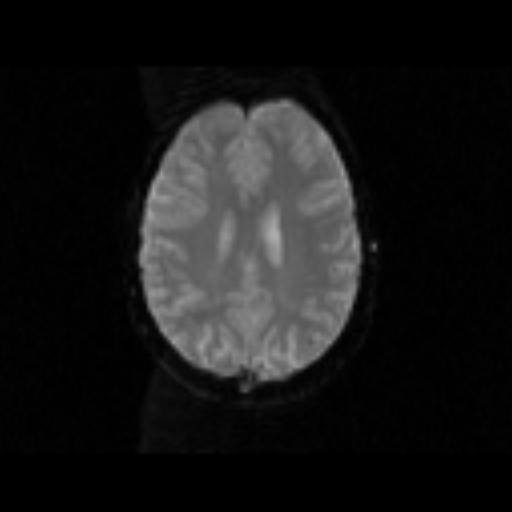 Deoxygenated blood attenuates signal in T 2* -weighted MR images O 2 MRI volume element