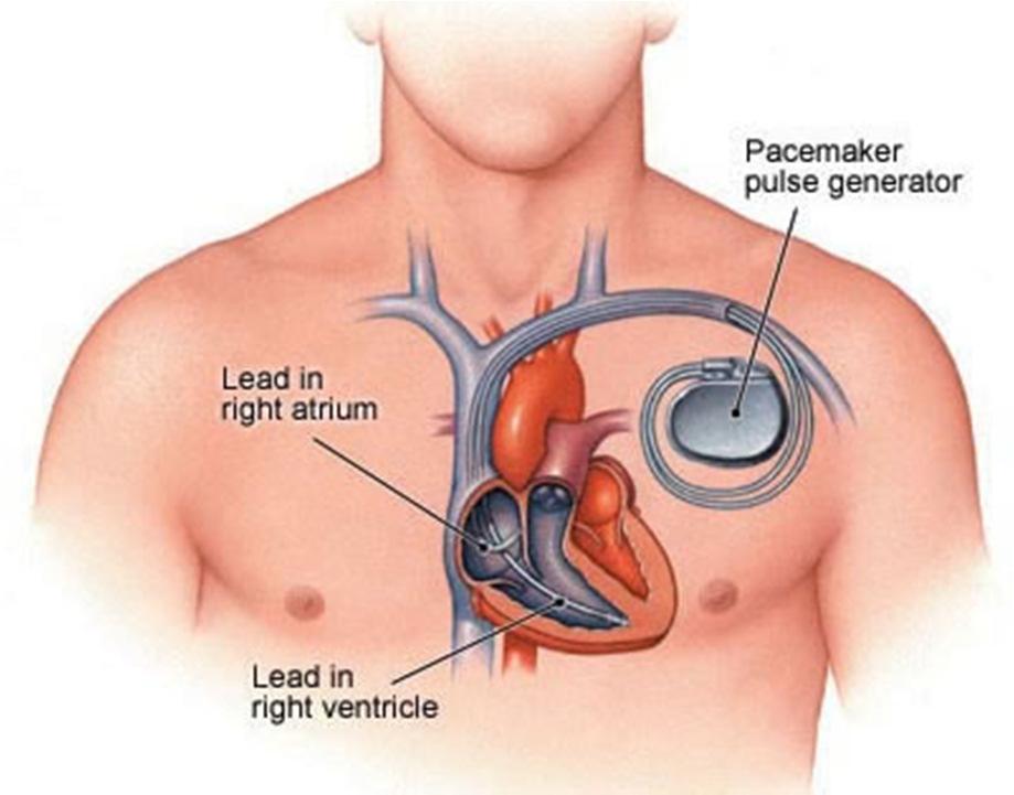 Cardiac pacemakers The Food and Drug Administration (FDA) issued 23 recalls of defective pacemaker devices during the first half of 2010 classified as Class I, meaning there is reasonable probability