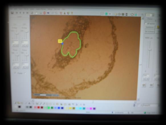 Laser Capture Microdissection of giant cells and RNA-seq Sample Total