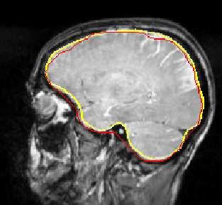 1 shows the inner skull boundary extracted from the bimodal MRI, compared with a boundary from a method that used only the