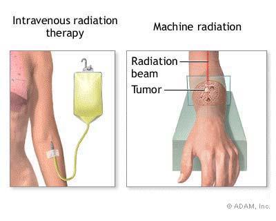 Using Radiation CANCER TREATMENT: cancer cells are more susceptible to damage by gamma rays than healthy