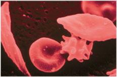 Sickle Cell Anemia The sickle cell trait is maintained by strong selective pressure because AS individuals
