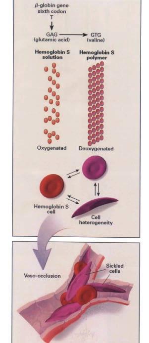 The sickle cell mutation in Hemoglobin: Sickle cell anemia is a blood condition seen most commonly