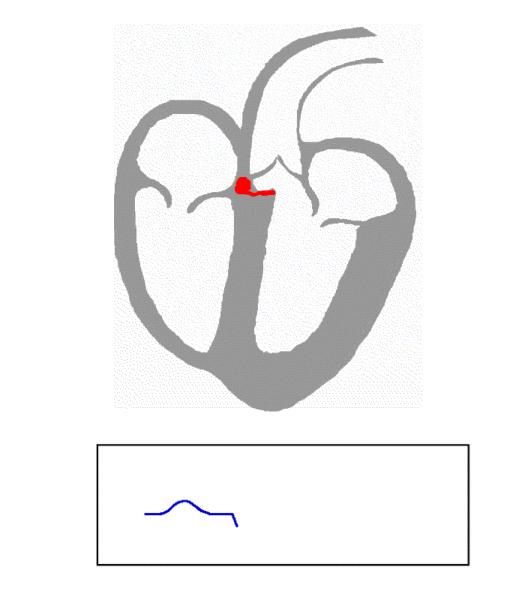 Cycle begins at the sinoatrial node. The sinus impulse is spread. Conduction atria. The AV-node receives the impulse. Short propagation delay (location of possible AV-blocks).