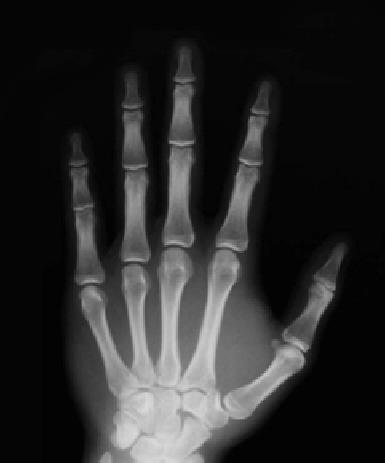 10. X-rays are used to diagnose and treat medical conditions. The image shows an X-ray photograph. (i) What are X-rays? (6) (ii) State a property of X-rays that makes them suitable for medical use.