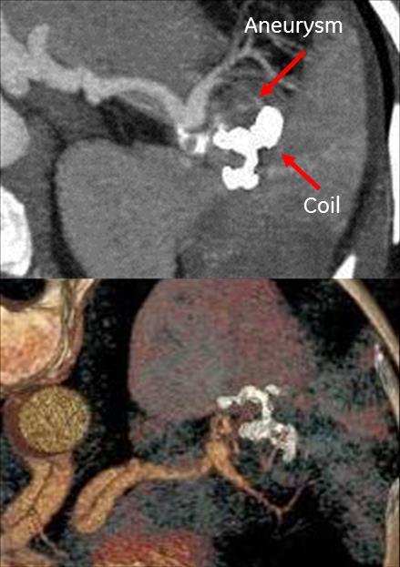 GSI enabled better visualization of splenic aneurysm embolization vs.