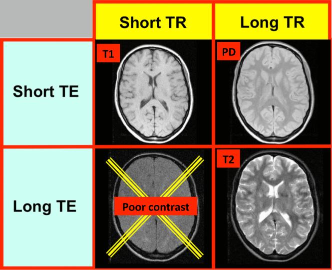 Image contrast P D, T 1 and T 2 are positively correlated maximizing the sensitivity to all of them (short T R and long T E) leads to