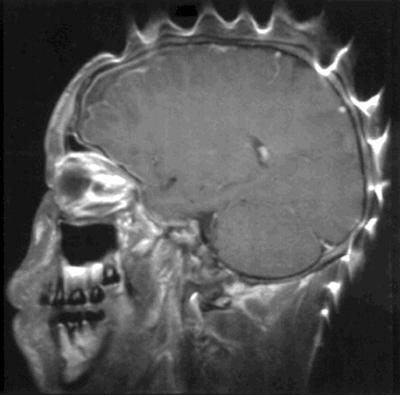 MRI artifacts Magnetic susceptibility artifacts Due to metal implants, characterized by