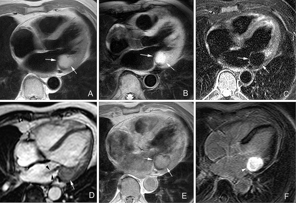 Cardiac MRI Non-invasive assessment of the function and structure of the