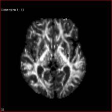 Processing Flow Chart Structural MRI T1w segmented Tw B0 Diffusion MRI DWI Alignment () (1) EPI Distortion