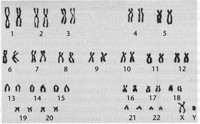 V. A Mistake in Meiosis Can Cause Down Syndrome Sometimes, meiosis does not happen perfectly, so the chromosomes are not divided completely equally between the daughter cells produced by meiosis.