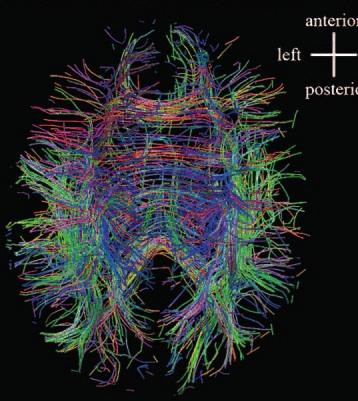 Tractography Once the diffusion tensor is found we can use its eigenvectors to define direction fields. Integrating these fields allows for the tracking of nerve fibers.