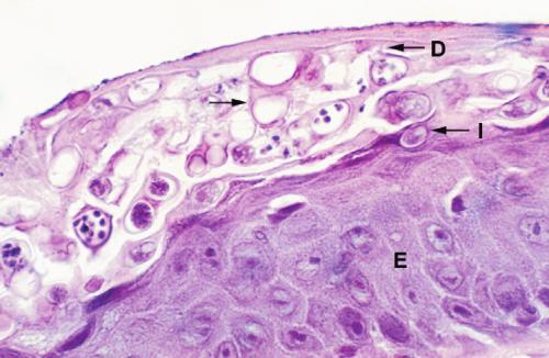 Histological section of skin from a Common green tree frog Litoria caerulea heavily infected with Batrachochytrium dendrobatidis.