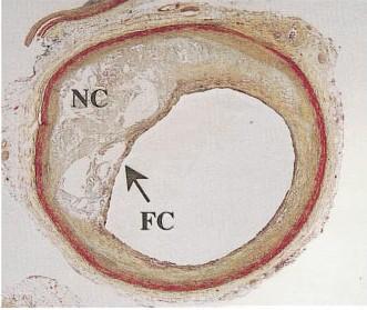 Atherosclerosis 3 Atherosclerosis is a vascular disease characterized by [Virmani et al.