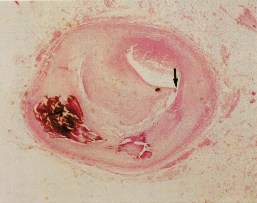 Vulnerable plaque, characterized by: non calcified, eccentric plaque; a thin fibrous cap (< 65 µm); a large lipid pool (> 40% plaque