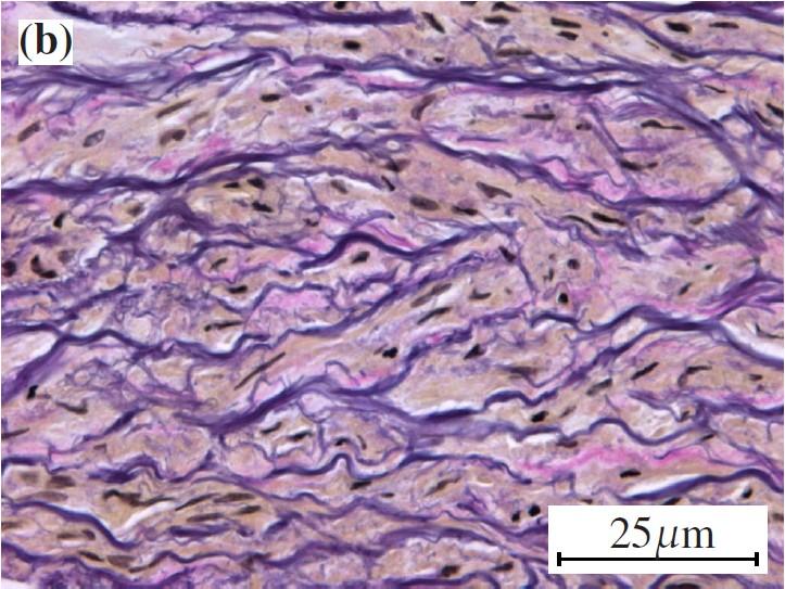 1985] proves: large dispersion of collagen fibers in the intima and adventitia; alignment of the collagen fibers