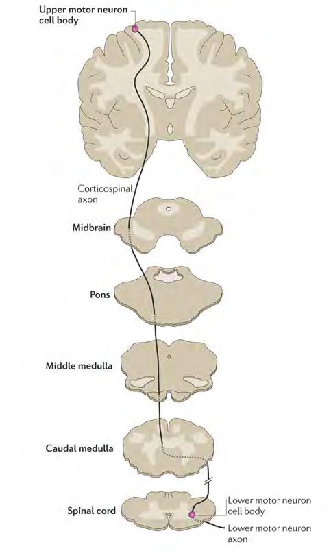 Hereditary spastic paraplegia: degeneration of the corticospinal tract HSP is characterized by stiffness, contraction, spasticity, and weakness of the lower extremities.