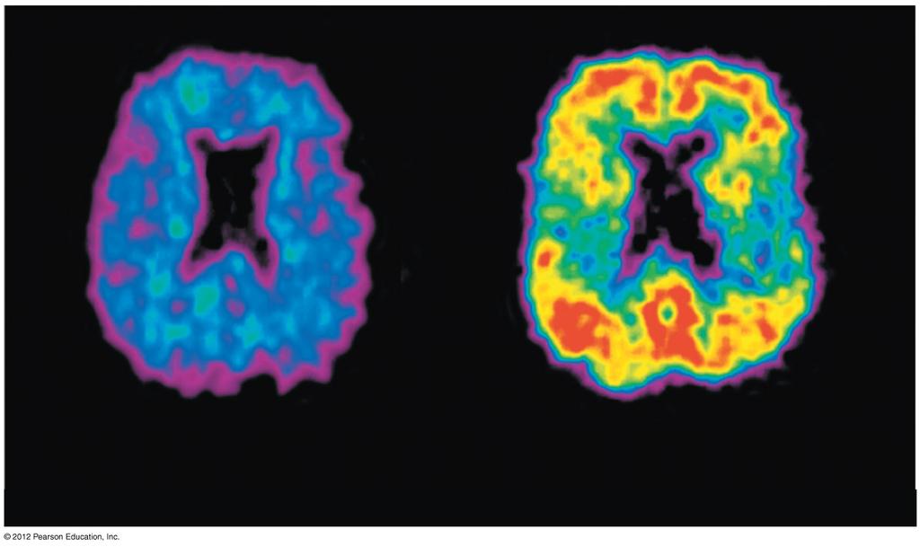An imaging instrument that uses positron-emission tomography (PET) detects the location of injected