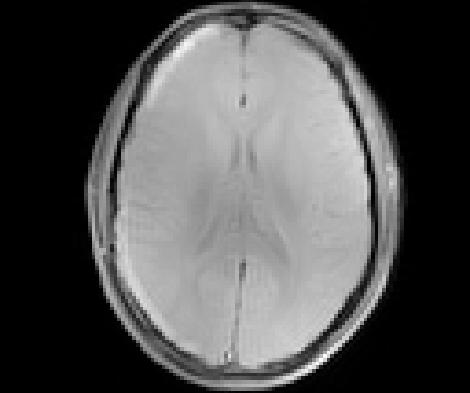 T1 and T Values Tissue T1 [ms] T [ms] gray matter 95 100