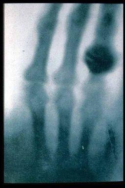 The first radiograph